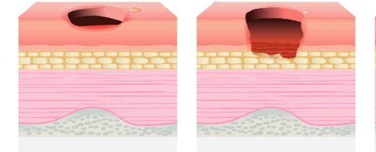 graphic of a pressure injury through skin and fat