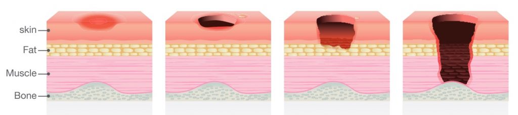 graphic of pressure injuries at different layers of skin and tissue